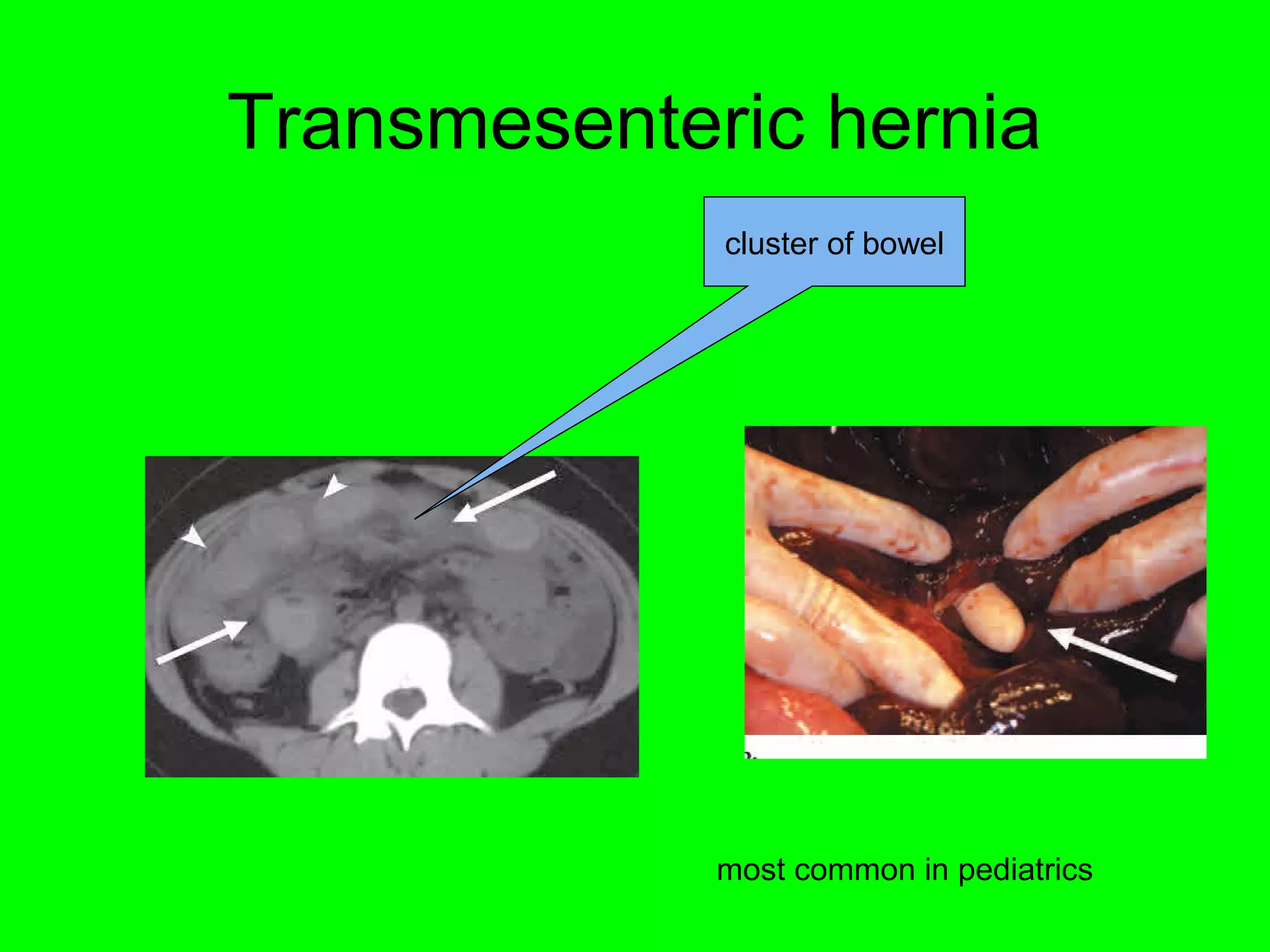 Transmesenteric hernia 
cluster of bowel 
most common in pediatrics 
 