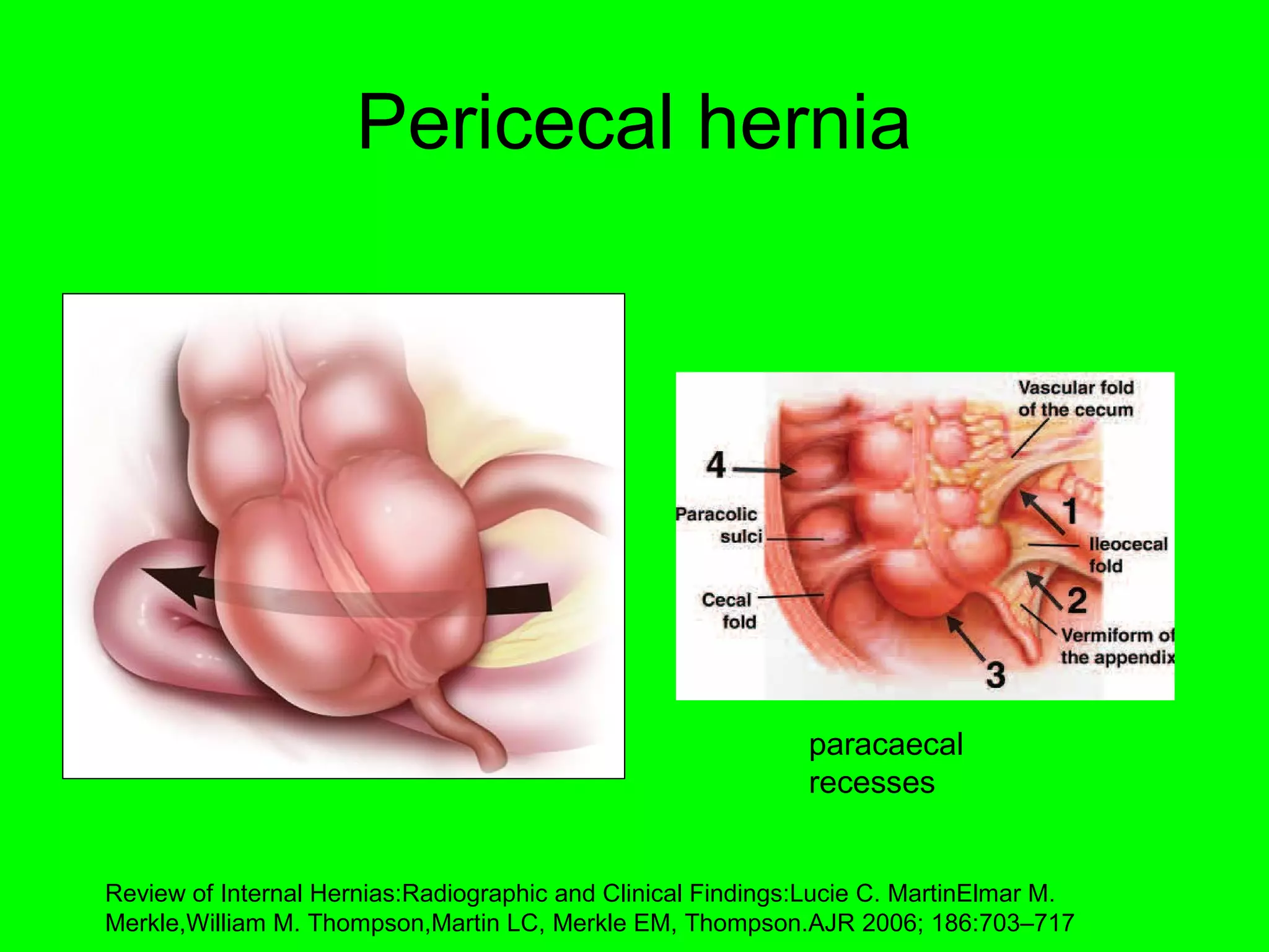Pericecal hernia 
paracaecal 
recesses 
Review of Internal Hernias:Radiographic and Clinical Findings:Lucie C. MartinElmar M. 
Merkle,William M. Thompson,Martin LC, Merkle EM, Thompson.AJR 2006; 186:703–717 
 