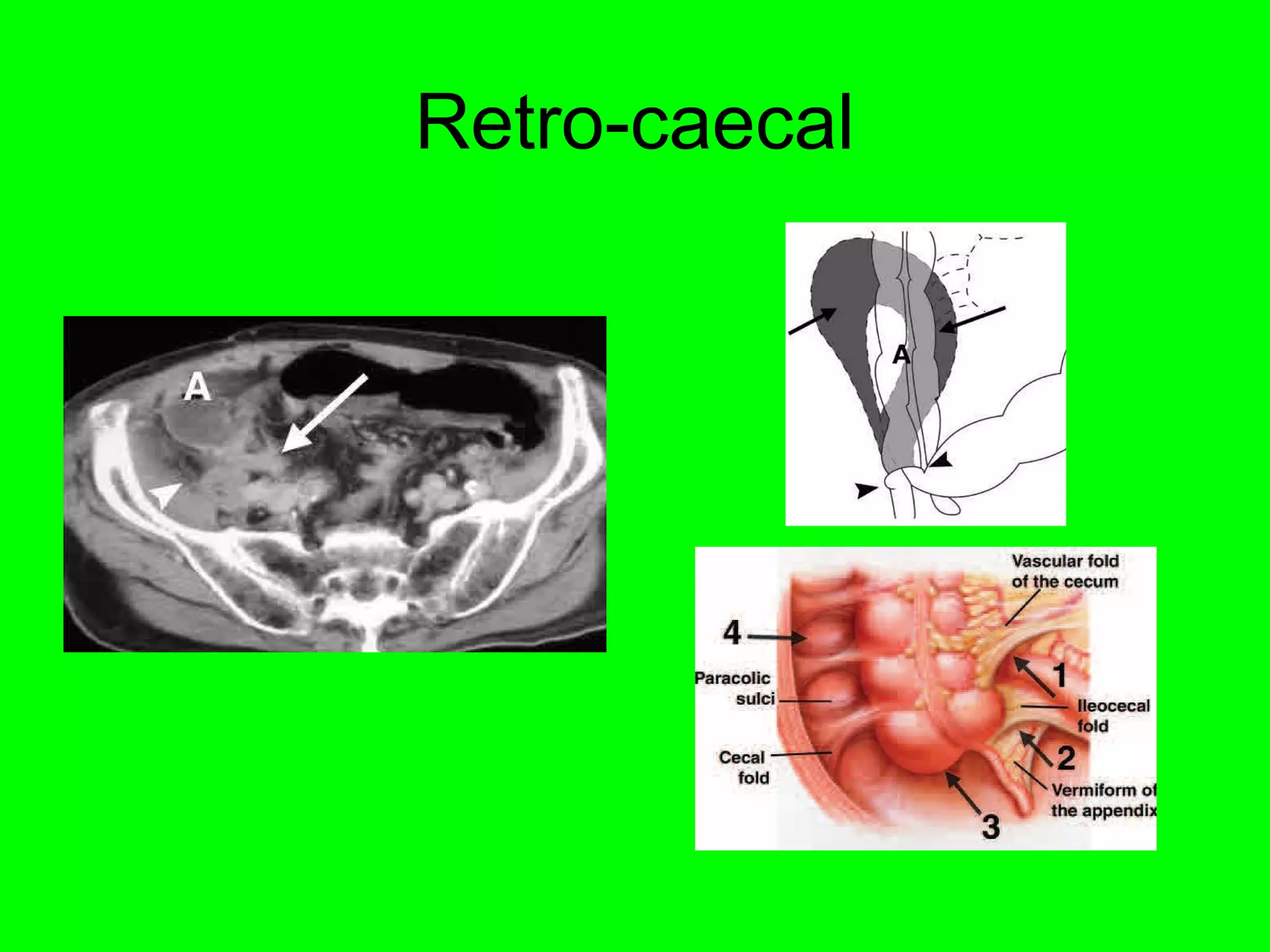 Retro-caecal 
 