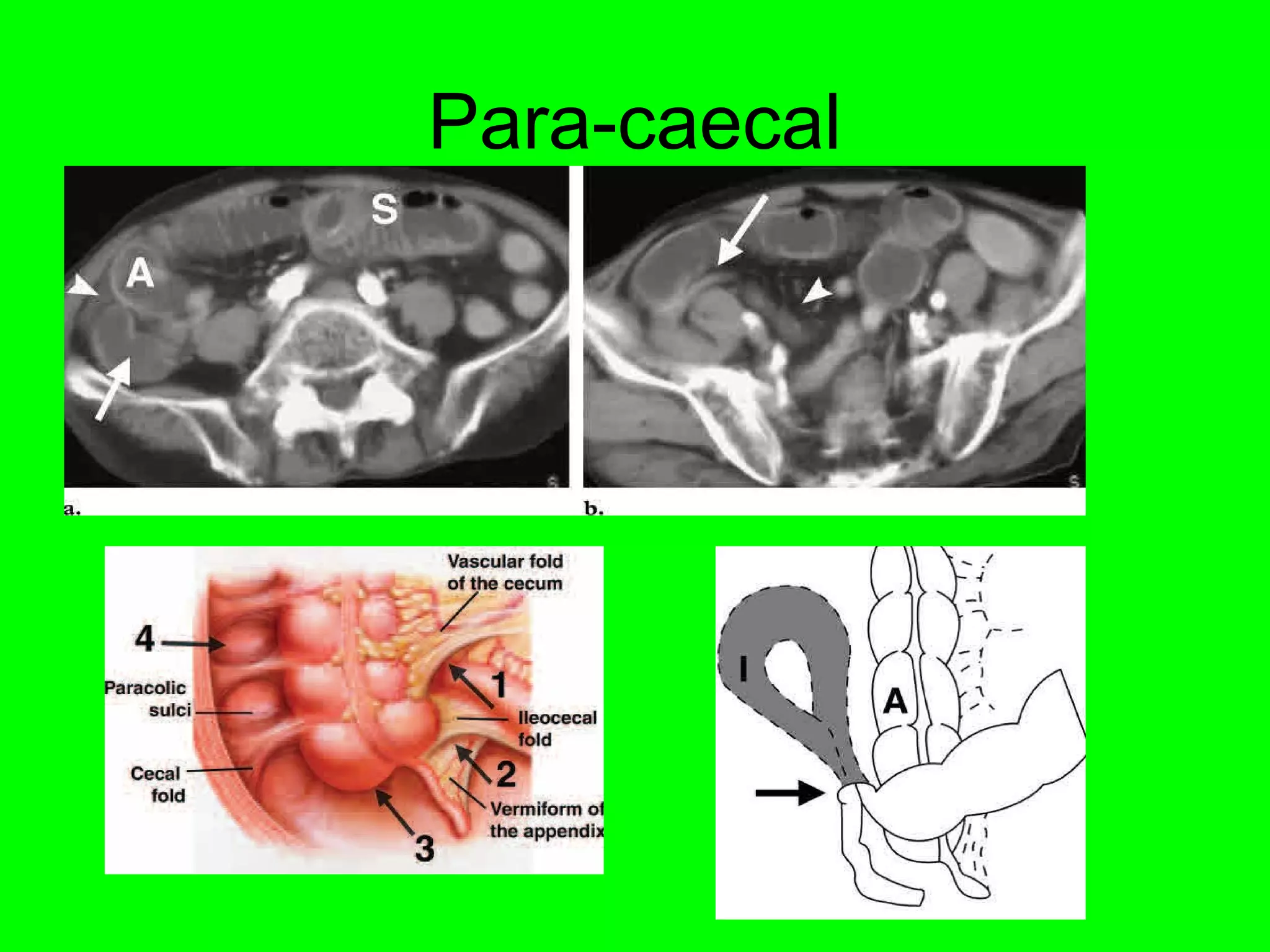 Para-caecal 
 
