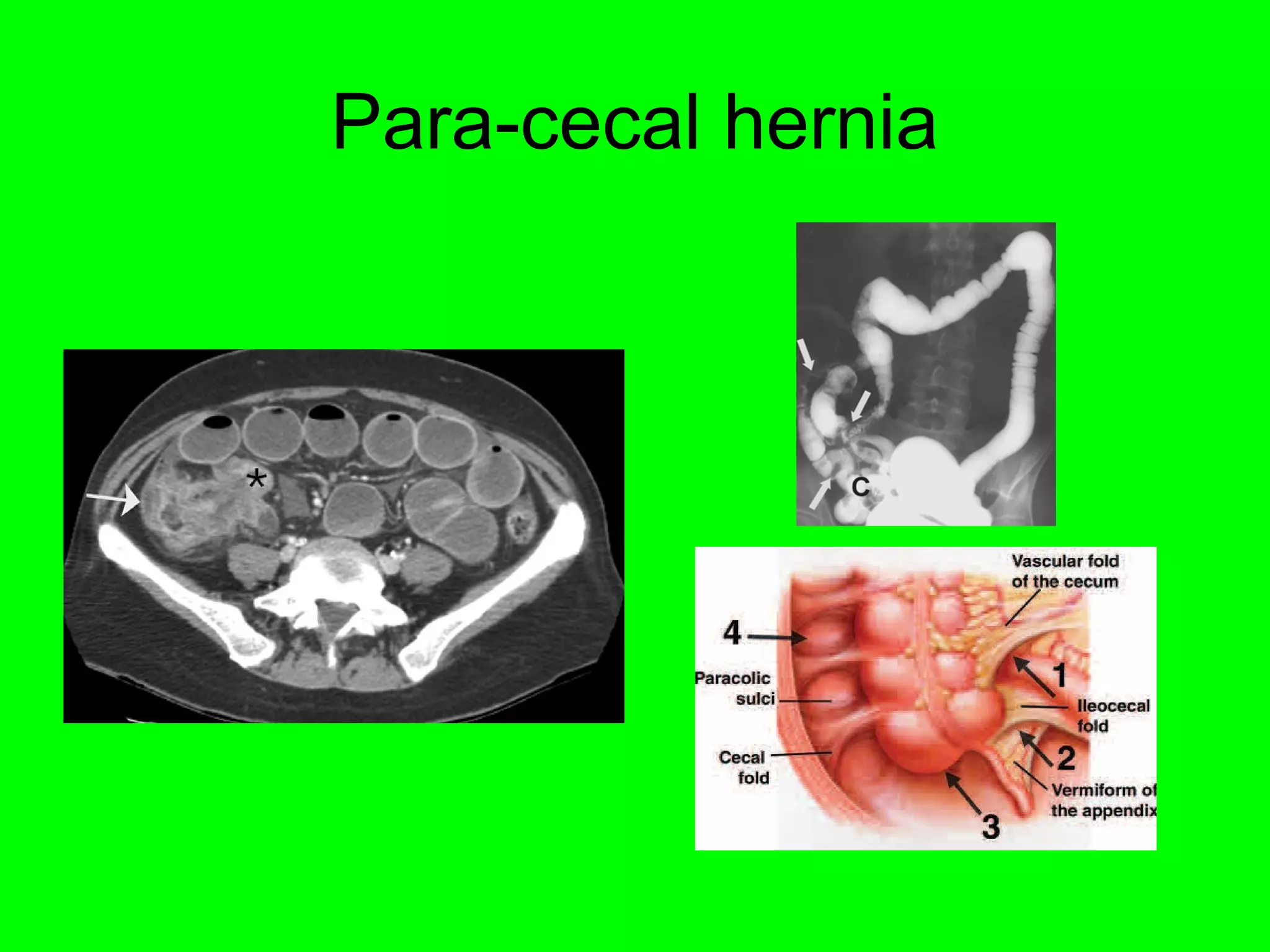 Para-cecal hernia 
 