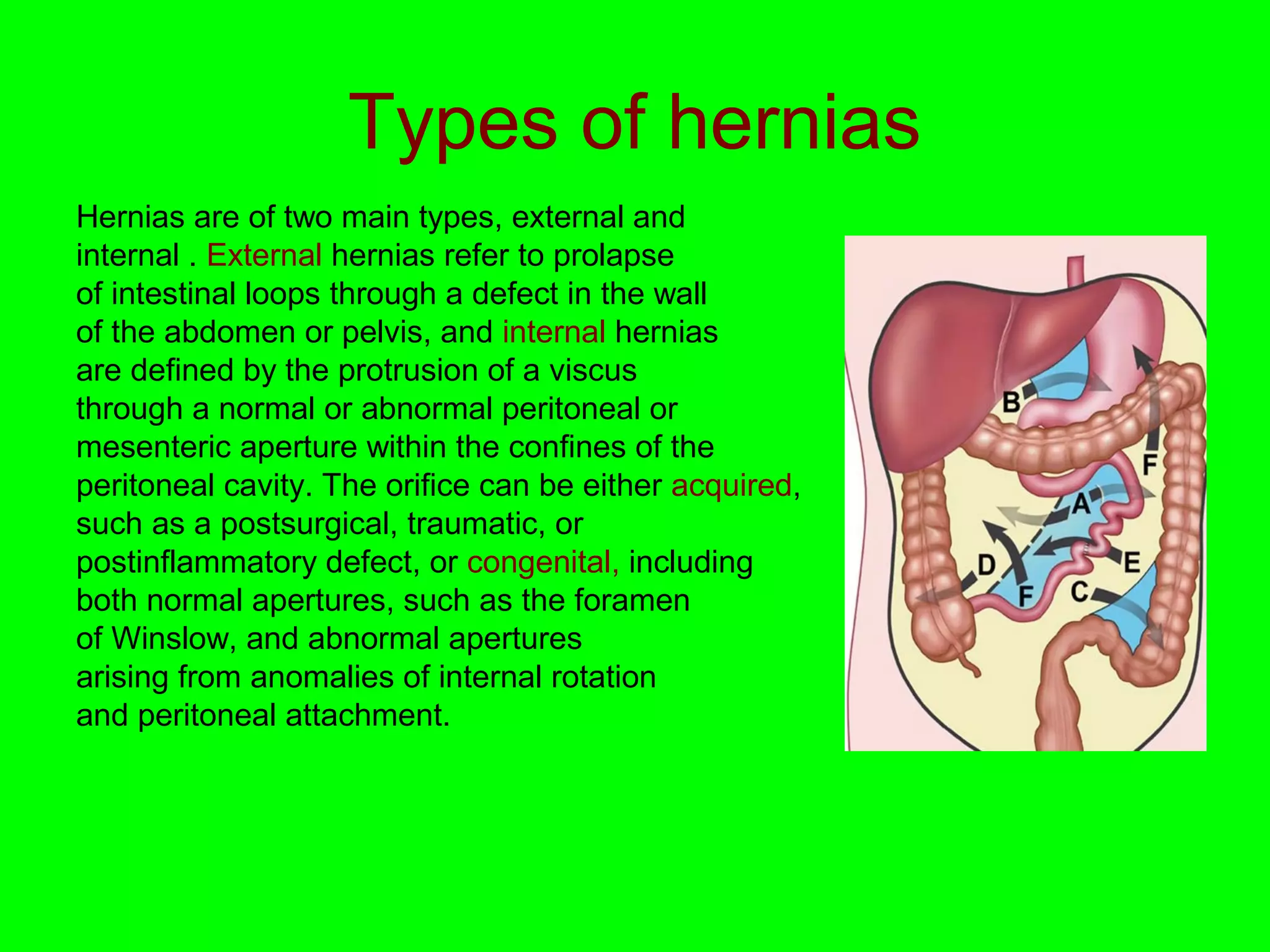 Types of hernias 
Hernias are of two main types, external and 
internal . External hernias refer to prolapse 
of intestinal loops through a defect in the wall 
of the abdomen or pelvis, and internal hernias 
are defined by the protrusion of a viscus 
through a normal or abnormal peritoneal or 
mesenteric aperture within the confines of the 
peritoneal cavity. The orifice can be either acquired, 
such as a postsurgical, traumatic, or 
postinflammatory defect, or congenital, including 
both normal apertures, such as the foramen 
of Winslow, and abnormal apertures 
arising from anomalies of internal rotation 
and peritoneal attachment. 
 