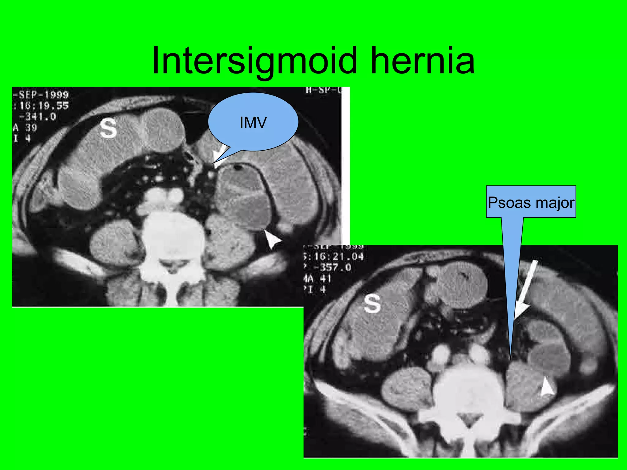 Intersigmoid hernia 
IMV 
Psoas major 
 