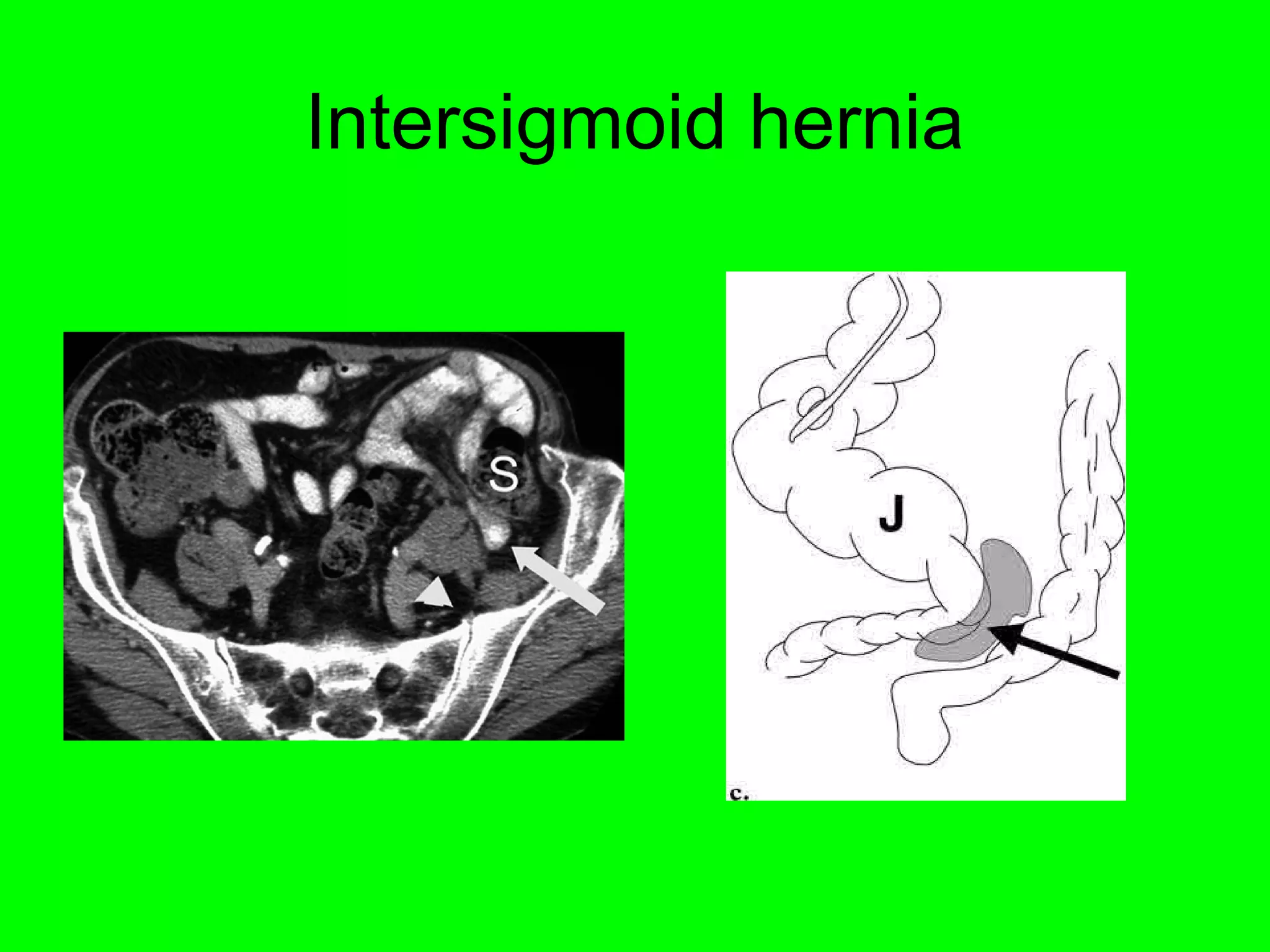 Intersigmoid hernia 
 