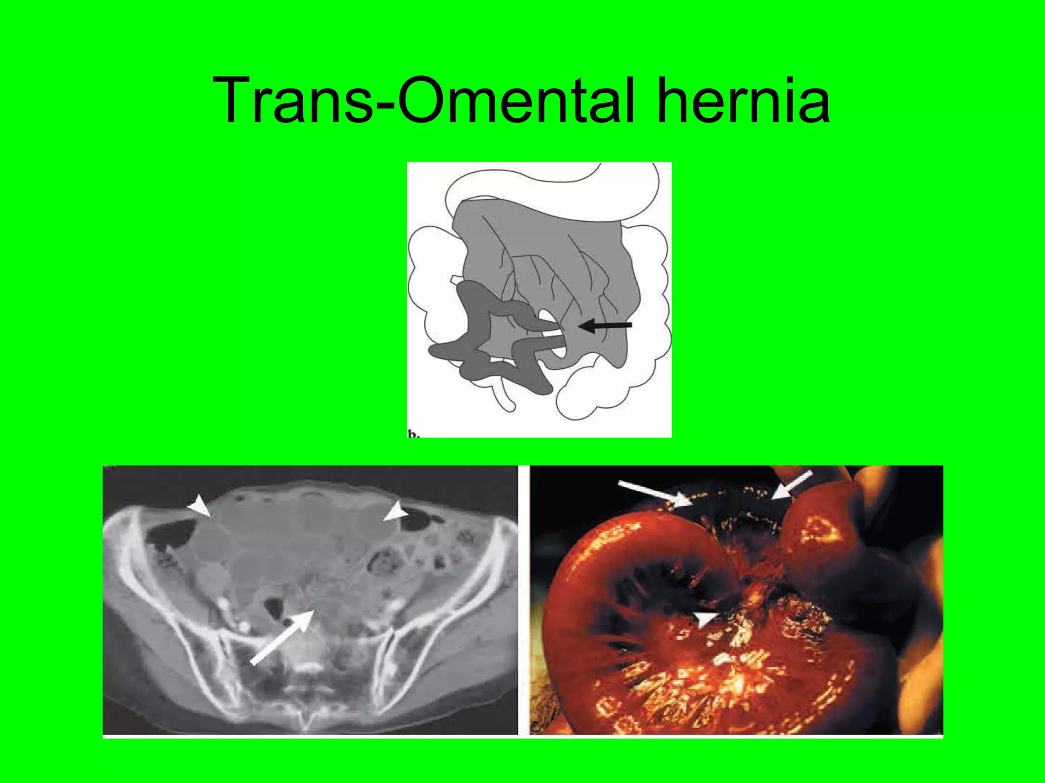 Trans-Omental hernia 
 