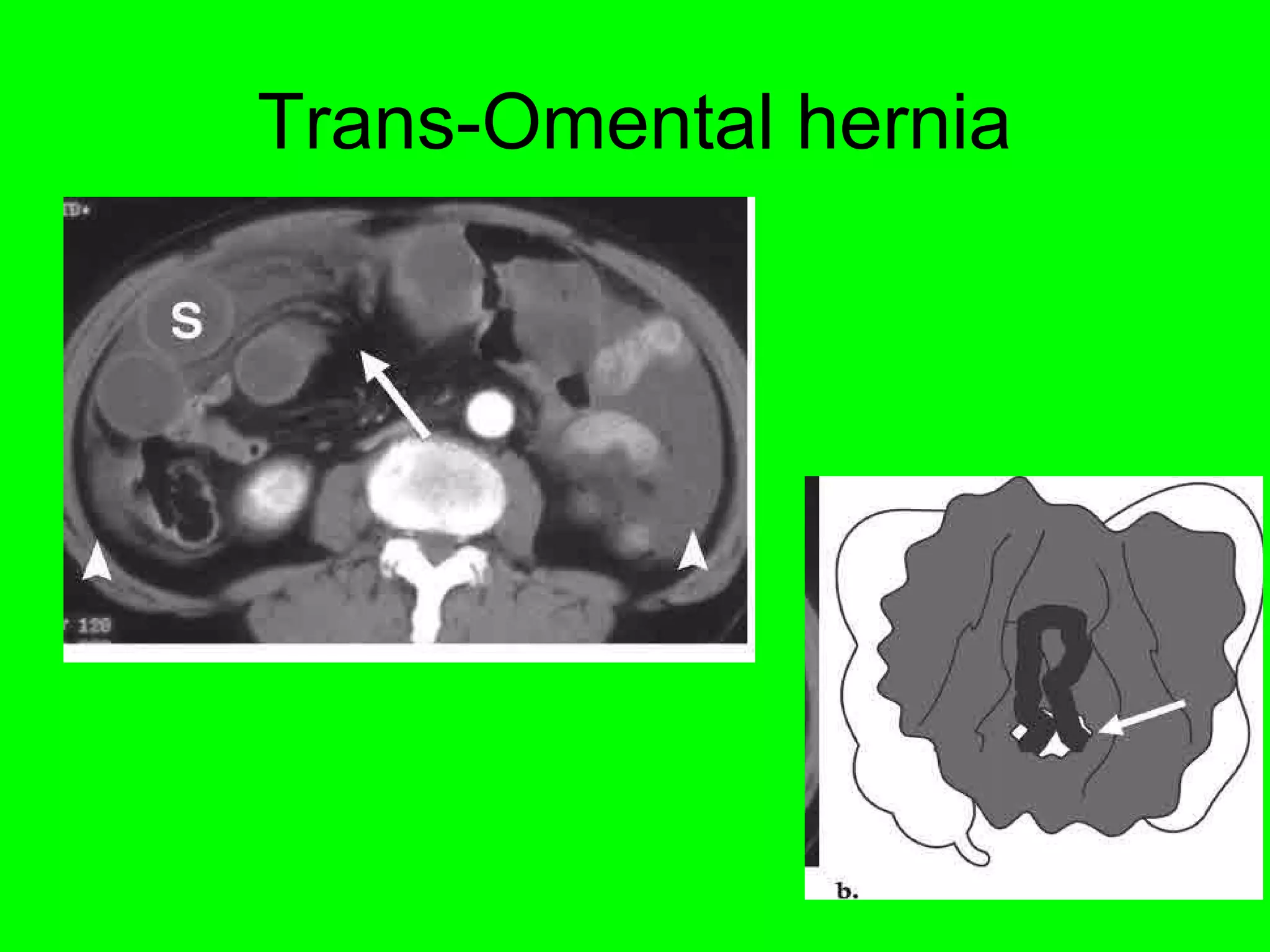 Trans-Omental hernia 
 