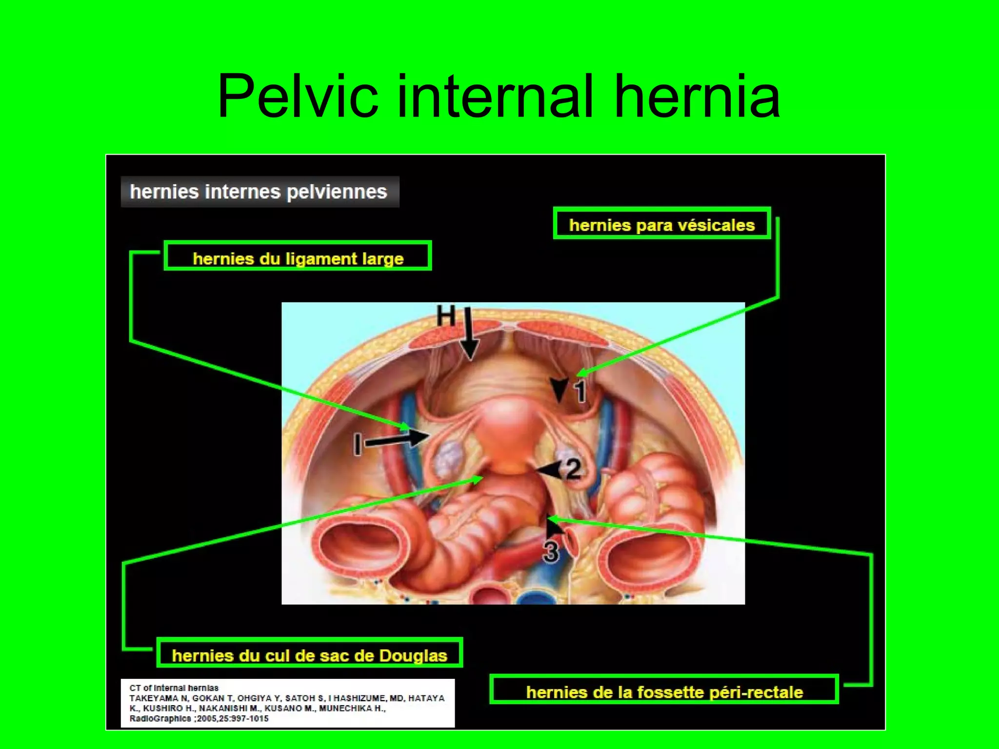 Pelvic internal hernia 
 