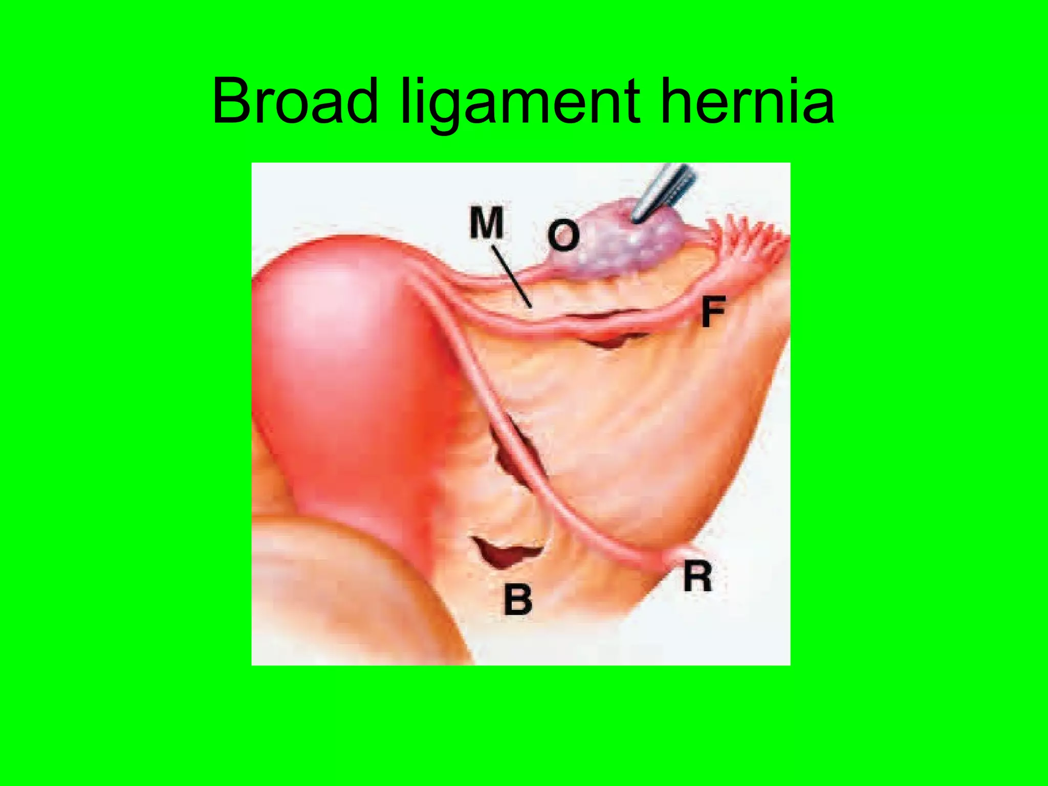 Broad ligament hernia 
 