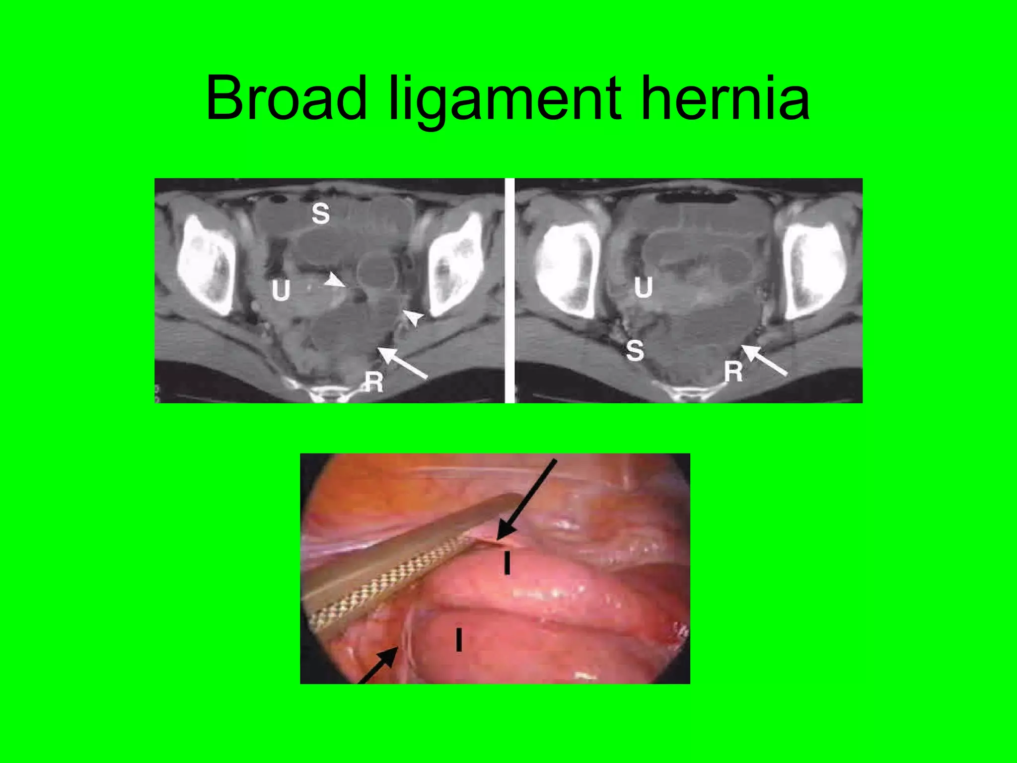 Broad ligament hernia 
 
