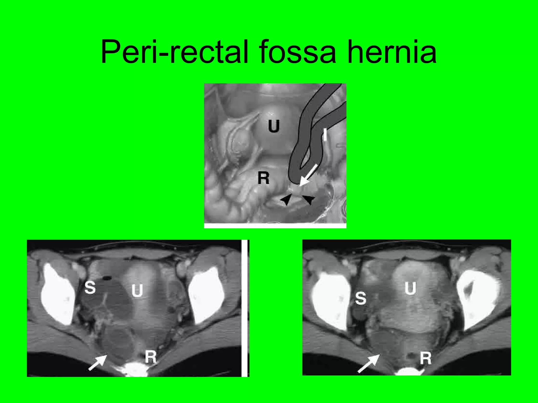 Peri-rectal fossa hernia 
 