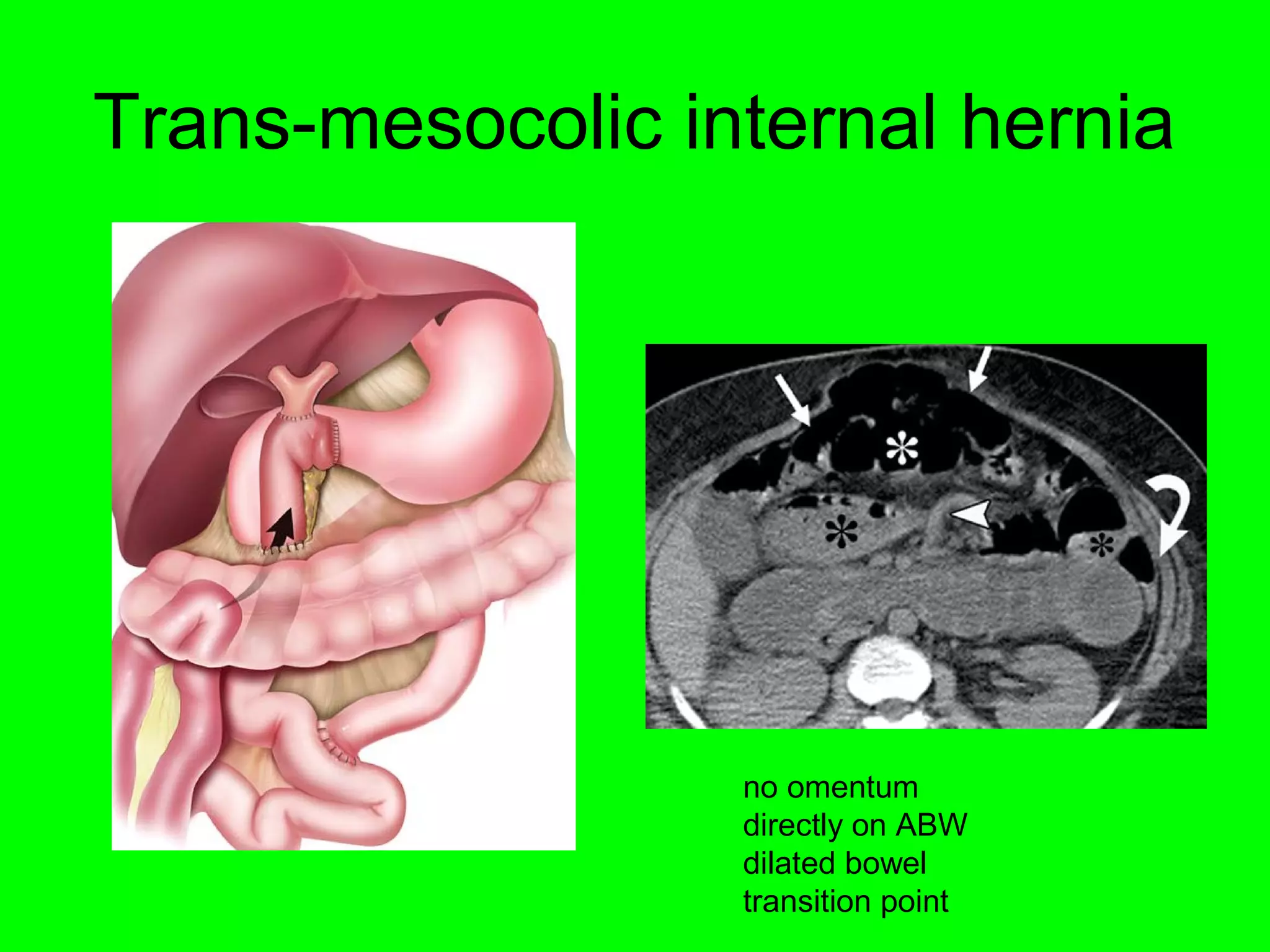 Trans-mesocolic internal hernia 
no omentum 
directly on ABW 
dilated bowel 
transition point 
 