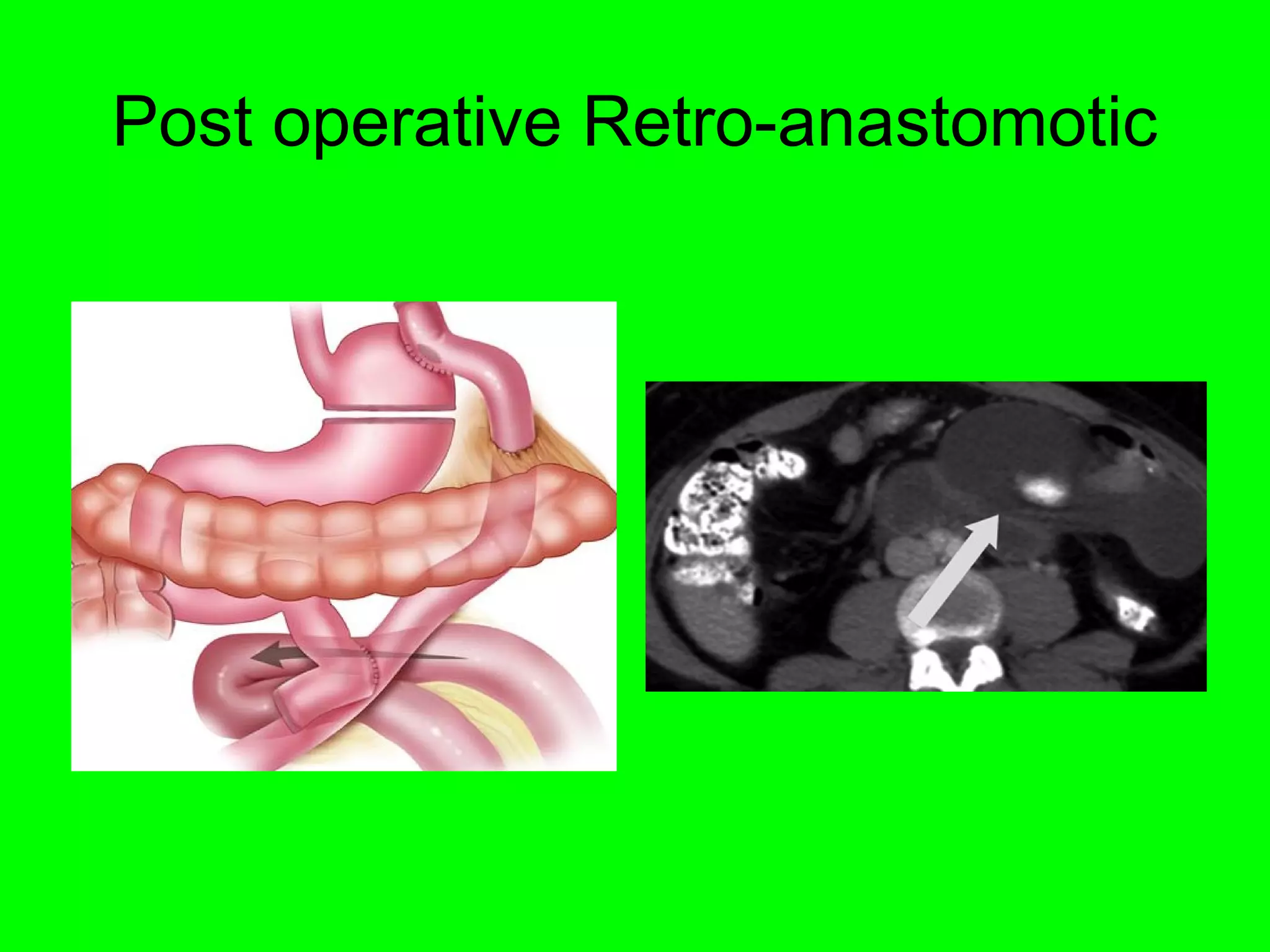 Post operative Retro-anastomotic 
 