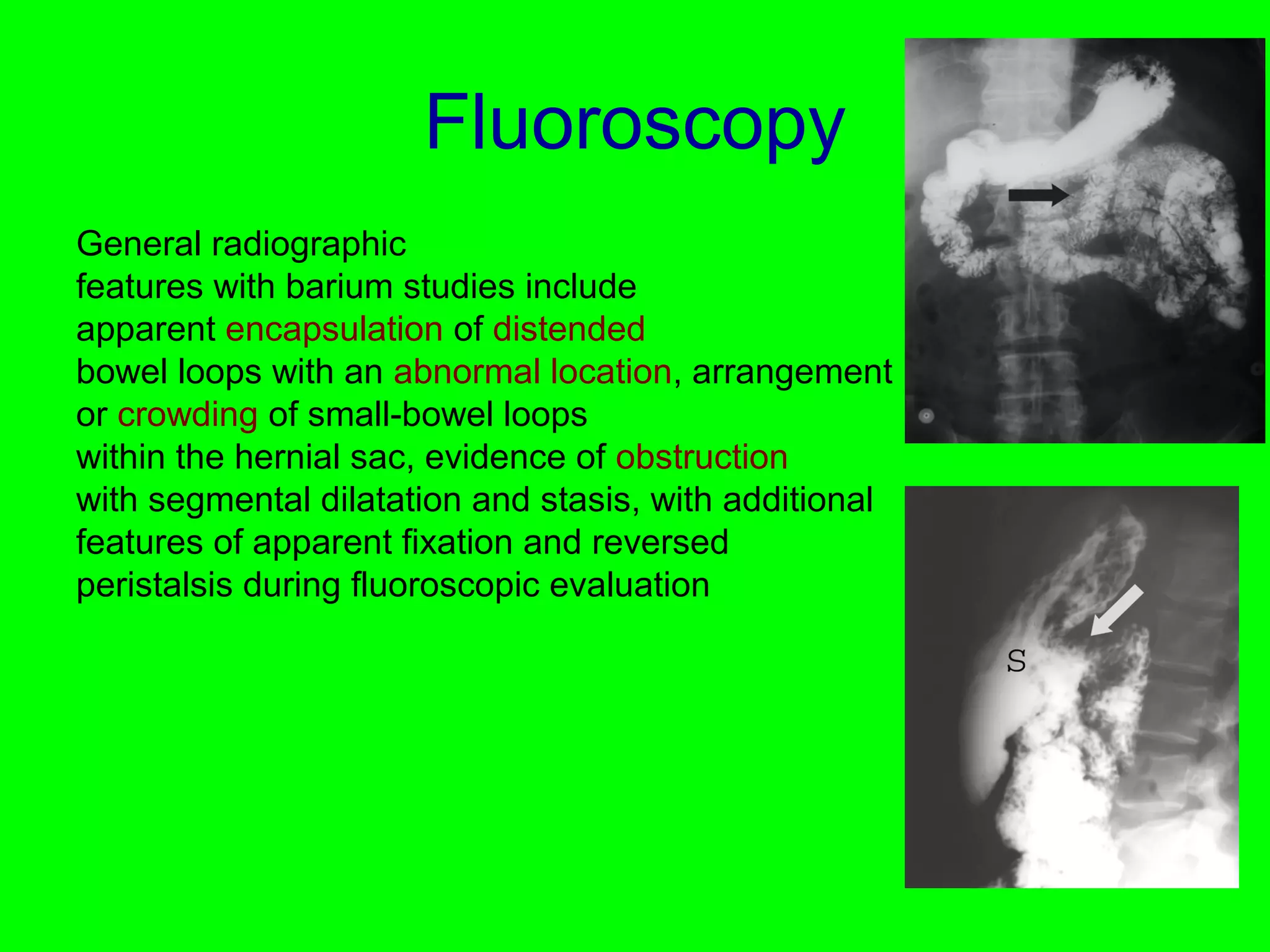 Fluoroscopy 
General radiographic 
features with barium studies include 
apparent encapsulation of distended 
bowel loops with an abnormal location, arrangement 
or crowding of small-bowel loops 
within the hernial sac, evidence of obstruction 
with segmental dilatation and stasis, with additional 
features of apparent fixation and reversed 
peristalsis during fluoroscopic evaluation 
 