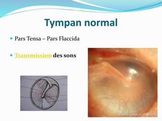 Tympan normal
 Pars Tensa – Pars Flaccida
 Transmission des sons
 