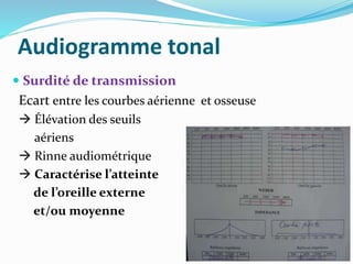 Audiogramme tonal
 Surdité de transmission
Ecart entre les courbes aérienne et osseuse
 Élévation des seuils
aériens
 Rinne audiométrique
 Caractérise l’atteinte
de l’oreille externe
et/ou moyenne
 