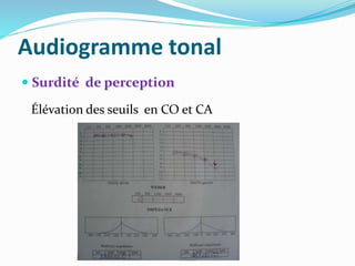 Audiogramme tonal
 Surdité de perception
Élévation des seuils en CO et CA
 