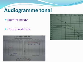 Audiogramme tonal
 Surdité mixte
 Cophose droite
 