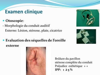 Examen clinique
 Otoscopie:
- Morphologie du conduit auditif
Externe: Lésion, sténose, plaie, cicatrice
 Evaluation des séquelles de l’oreille
externe
Brûlure du pavillon
sténose complète du conduit
Préjudice esthétique + +
IPP: 1 à 5 %
 