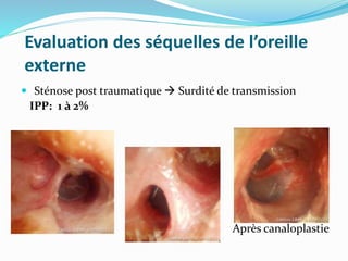 Evaluation des séquelles de l’oreille
externe
 Sténose post traumatique  Surdité de transmission
IPP: 1 à 2%
Après canaloplastie
 
