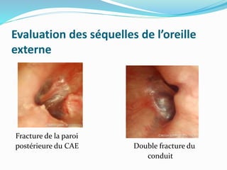 Evaluation des séquelles de l’oreille
externe
Fracture de la paroi
postérieure du CAE Double fracture du
conduit
 