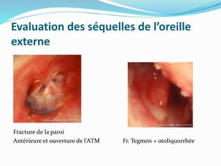 Evaluation des séquelles de l’oreille
externe
Fracture de la paroi
Antérieure et ouverture de l’ATM Fr. Tegmen + otoliquorrhée
 
