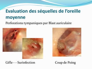 Evaluation des séquelles de l’oreille
moyenne
Perforations tympaniques par Blast auriculaire
Gifle - - Surinfection Coup de Poing
 