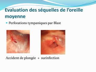 Evaluation des séquelles de l’oreille
moyenne
 Perforations tympaniques par Blast
Accident de plongée + surinfection
 