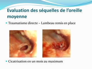 Evaluation des séquelles de l’oreille
moyenne
 Traumatisme directe – Lambeau remis en place
 Cicatrisation en un mois au maximum
 