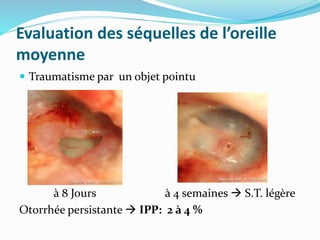 Evaluation des séquelles de l’oreille
moyenne
 Traumatisme par un objet pointu
à 8 Jours à 4 semaines  S.T. légère
Otorrhée persistante  IPP: 2 à 4 %
 