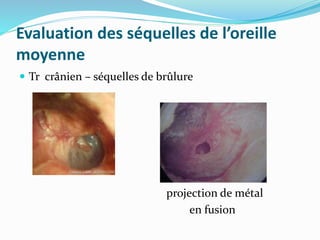 Evaluation des séquelles de l’oreille
moyenne
 Tr crânien – séquelles de brûlure
projection de métal
en fusion
 