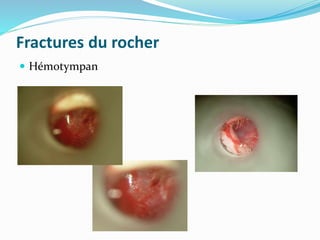 Fractures du rocher
 Hémotympan
 