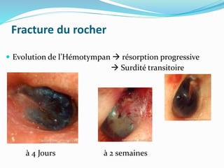 Fracture du rocher
 Evolution de l’Hémotympan  résorption progressive
 Surdité transitoire
à 4 Jours à 2 semaines
 
