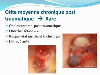 Otite moyenne chronique post
traumatique  Rare
 Cholestéatome post traumatique
 Otorrhée fétide + +
 Risque vital justifiant la chirurgie
 IPP: 15 à 20%
 