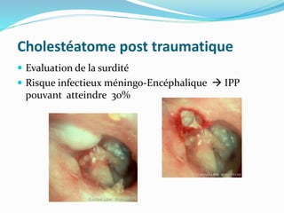 Cholestéatome post traumatique
 Evaluation de la surdité
 Risque infectieux méningo-Encéphalique  IPP
pouvant atteindre 30%
 