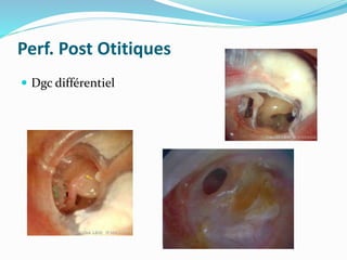 Perf. Post Otitiques
 Dgc différentiel
 