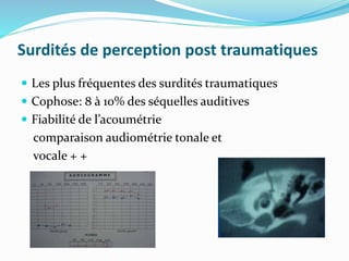 Surdités de perception post traumatiques
 Les plus fréquentes des surdités traumatiques
 Cophose: 8 à 10% des séquelles auditives
 Fiabilité de l’acoumétrie
comparaison audiométrie tonale et
vocale + +
 