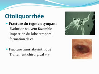 Otoliquorrhée
 Fracture du tegmen tympani
Evolution souvent favorable
Impaction du lobe temporal
formation de cal
 Fracture translabyrinthique
Traitement chirurgical + +
 