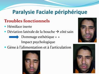 Paralysie Faciale périphérique
Troubles fonctionnels
 Hémiface inerte
 Déviation latérale de la bouche  côté sain
Dommage esthétique + +
Impact psychologique
 Gène à l’alimentation et à l’articulation
 