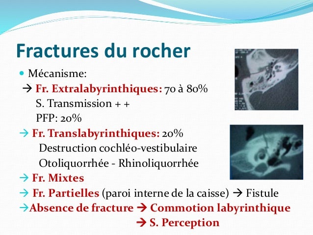 Fracture Rocher Fracture Du Rocher Anatomie , Le rocher, de l’anatomie à la ...