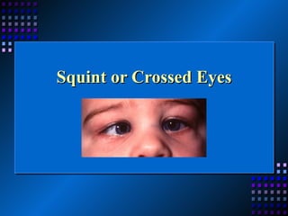 Squint or Crossed Eyes 