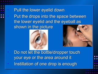 Pull the lower eyelid down Put the drops into the space between the lower eyelid and the eyeball as shown in the picture Do not let the bottle/dropper touch your eye or the area around it Instillation of one drop is enough 