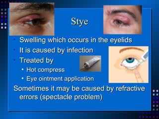Stye Swelling which occurs in the eyelids It is caused by infection Treated by  Hot compress  Eye ointment application Sometimes it may be caused by refractive errors (spectacle problem)  