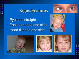 Signs/Features Eyes not straight Face turned to one side Head tilted to one side 