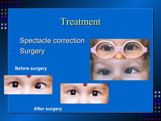 Treatment Spectacle correction Surgery  Before surgery After surgery 