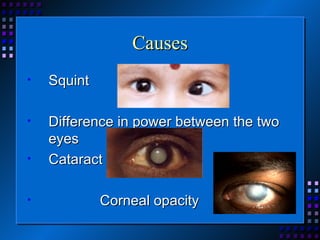 Causes Squint Difference in power between the two eyes  Cataract  Corneal opacity 