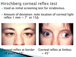  Used as initial screening test for strabismus.
 Amount of deviation: note location of corneal light
reflex 1 mm = 7° or 15Δ
Corneal reflex at border
of pupil = 15°
Corneal reflex at limbus
= 45°
 