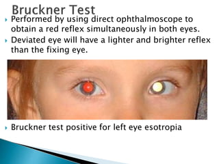  Performed by using direct ophthalmoscope to
obtain a red reflex simultaneously in both eyes.
 Deviated eye will have a lighter and brighter reflex
than the fixing eye.
 Bruckner test positive for left eye esotropia
 