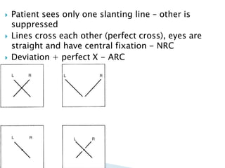 Patient sees only one slanting line – other is
suppressed
 Lines cross each other (perfect cross), eyes are
straight and have central fixation - NRC
 Deviation + perfect X - ARC
 
