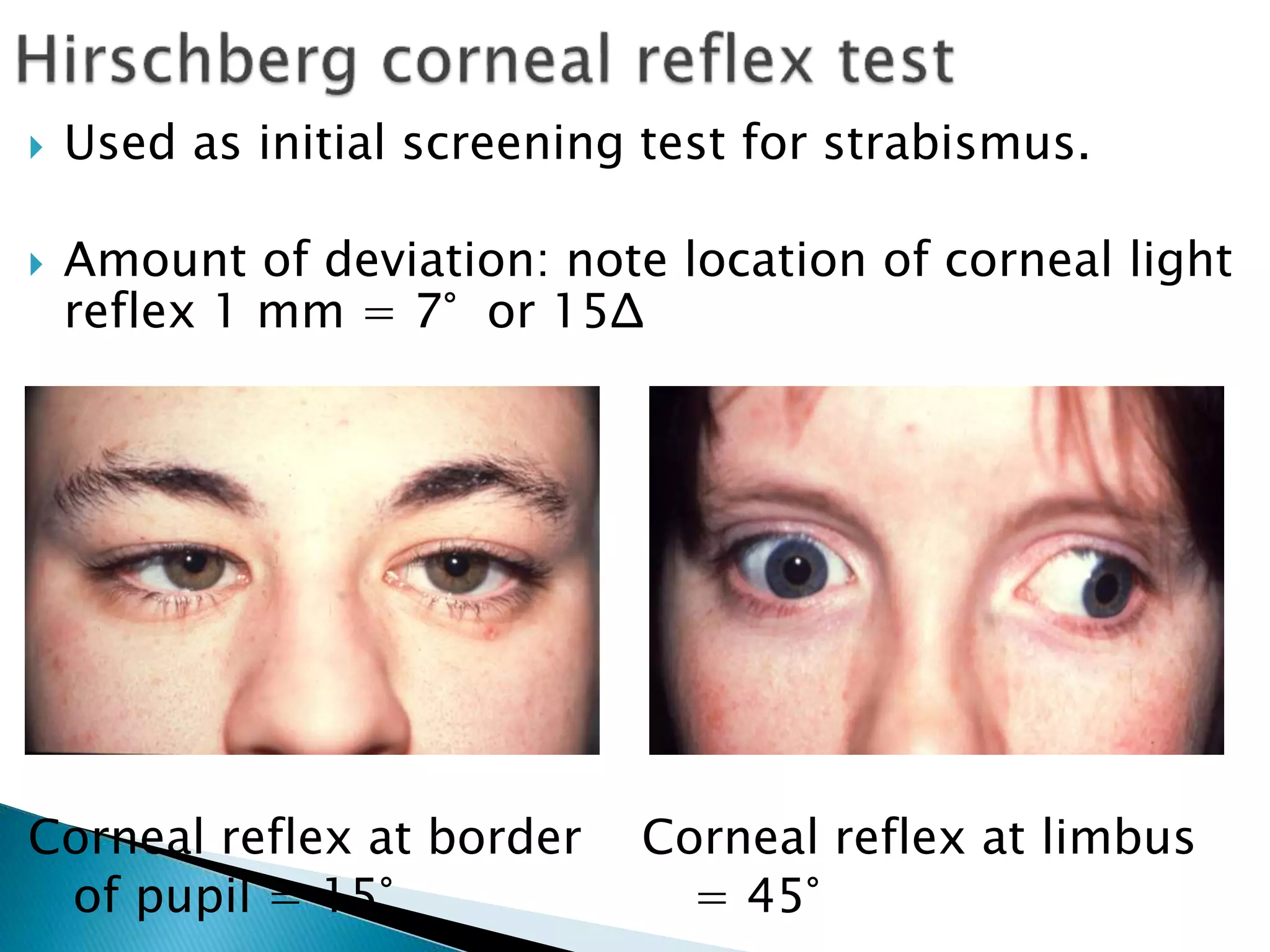  Used as initial screening test for strabismus.
 Amount of deviation: note location of corneal light
reflex 1 mm = 7° or 15Δ
Corneal reflex at border Corneal reflex at limbus
of pupil = 15° = 45°
 