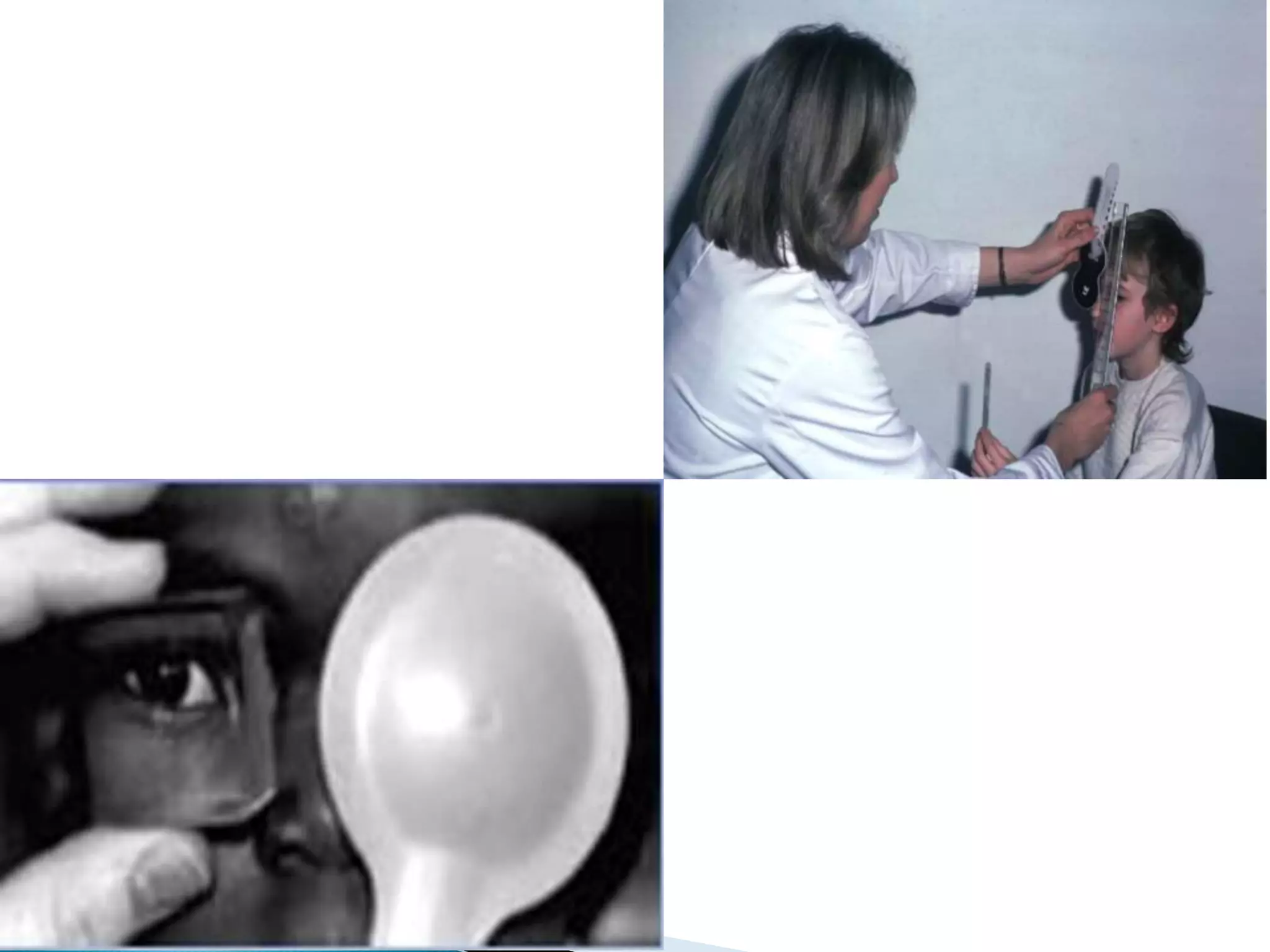 Squint | PPT